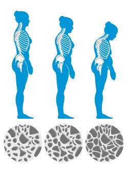 Im Laufe der Jahre schwindet die Knochenmasse und das Knochengerüst wird poröser – viele Patient:innen werden kleiner