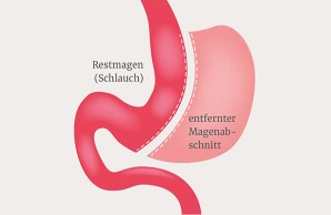 Der Schlauchmagen zählt zu den häufigsten Ersteingriffen bei stark übergewichtigen Patientinnen und Patienten