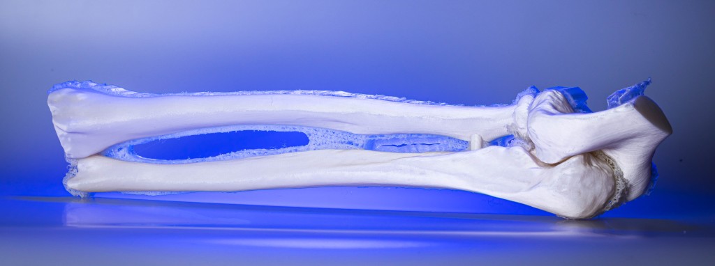 Auch in der Unfallchirurgie bietet der 3D-Druck enormes Potenzial. Operationen lassen sich besser planen, Eingriffe kürzer und schonender gestalten, Ergebnisse werden präziser. Operateure schauen sich ein gedruckte 3D-Knochenmodell an.