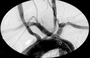 Einzelframe aus einer Angiographie