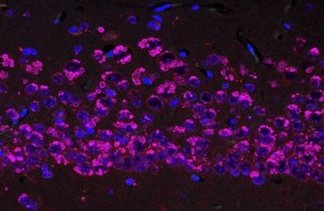  Accumulation of inclusion bodies in the CA1 region of the hippocampus of transgenic mice overexpressing S49P-Syracuse mutant neuroserpin.