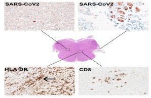 Marked reactive activation of microglia (HLA-DR) with occasional microglia nodules (black arrow). Infiltration of T lymphocytes (CD8). Scarce presence of SARS-CoV-2 proteins in isolated cells within the CNS and in cranial nerves.