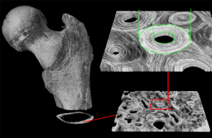 3D Femur