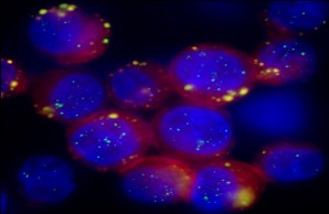 Hypoxic stress reaction in breast cancer cells