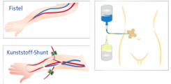 Dialysezugänge