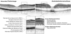 OCT-Biomarker der Ischämie beim akuten Zentralarterienverschluss der Netzhaut (aus Wenzel et al., 2021)