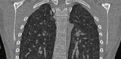 Computertomographie des Oberkörpers