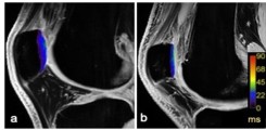 2.	Color map: Sagittale Quantitative T2*-Sequenz der medialen patellaren Gelenkfacette bei einem Normalproband (a) und einem professionellen Fussballspieler (b), zur Bestimmung der spezifischen T2*-Relaxationszeiten im retropatellaren Knorpelgewebe.