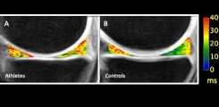MRT des Kniegelenks  3. Color map: Sagittale quantitative T1rho-Sequenz bei einer professionellen Volleyballerin (A) und einer Normalprobandin