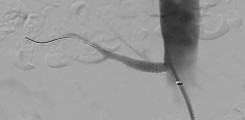 Stent-Behandlung einer Nierenarterienstenose