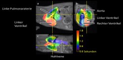 Analyse der Ankunftszeit eines injizierten magnetischen Tracers zeigt in Rot die Ankunft im rechten Ventrikel, danach in Gelb den Verlauf durch die Lungengefäße und in Blau die Ankunft im linken Ventrikel.