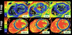 1.	T2- und T1-Karten bei einer 45-jährigen Patientin mit Mammakarzinom. T2- und T1-Relaxationszeiten erhöhten sich signifikant nach Abschluss der Epirubicin-basierten Chemotherapie, um sich im weiteren Verlauf zu normalisieren.