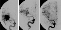 Angiographie eines Angioms