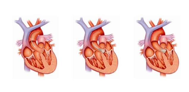 Kathetergestützter Ersatz der Aortenklappe mit CoreValve Prothese