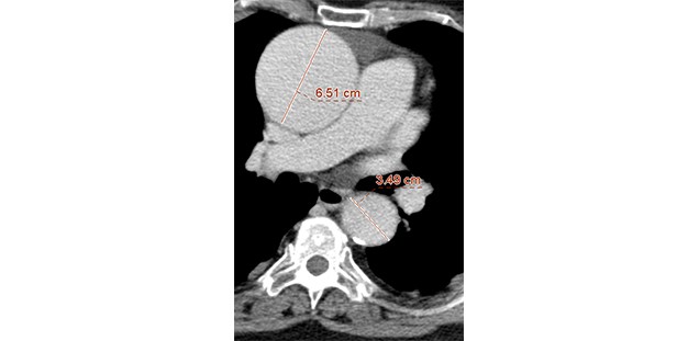 Aneurysma im Querschnitt