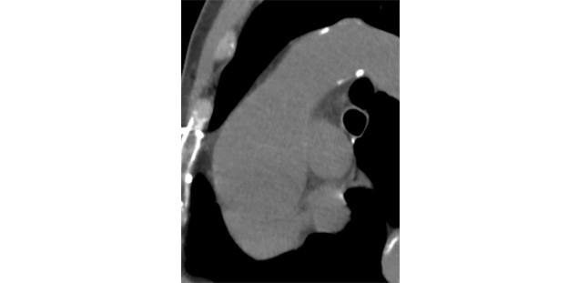 Aneurysma im Längsschnitt