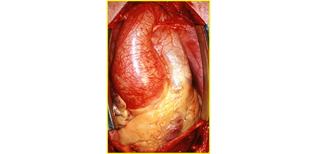 Wurzelaneurysma OP situs