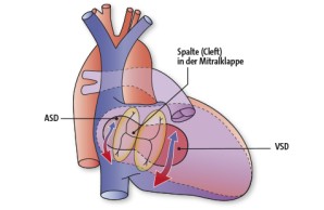 AVSD | Atrioventrikulärer Septumdefekt