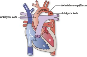 Aortenisthmusstenose