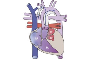 Hypoplastisches Linksherzsyndrom (HLHS) und Norwood-OP