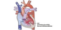 VSD | Ventrikulärer Septumdefekt (Kammerscheidewanddefekt)